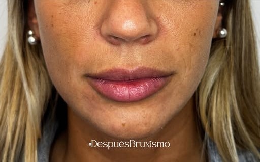 Después del tratamiento de bruxismo