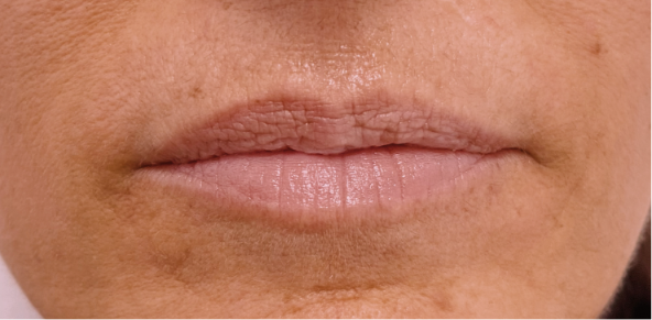 Antes del relleno de labios