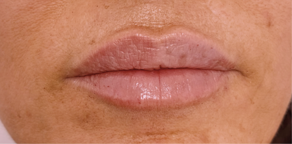 Después del relleno de labios