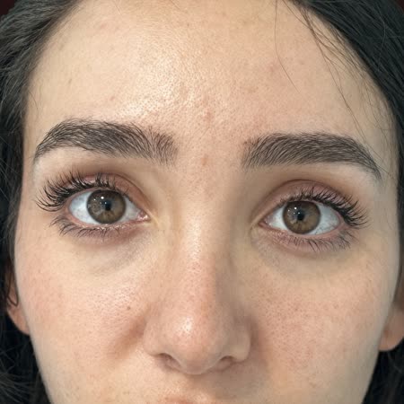 Antes del tratamiento de ojeras