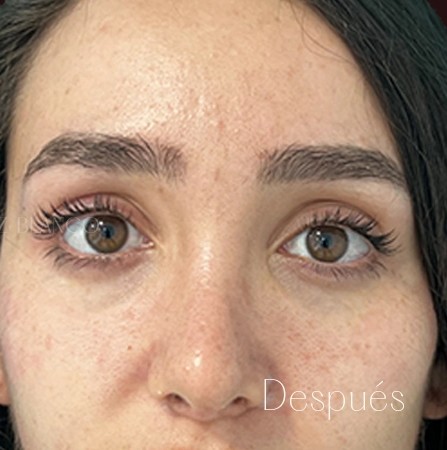 Después del tratamiento de ojeras
